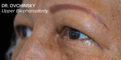 Blepharoplasty Before & After Patient #17785