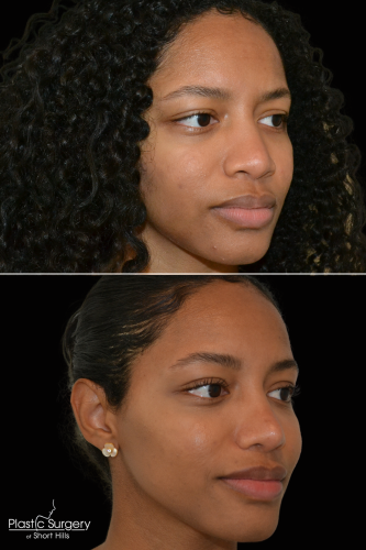 Ethnic Rhinoplasty Short Hills NJ