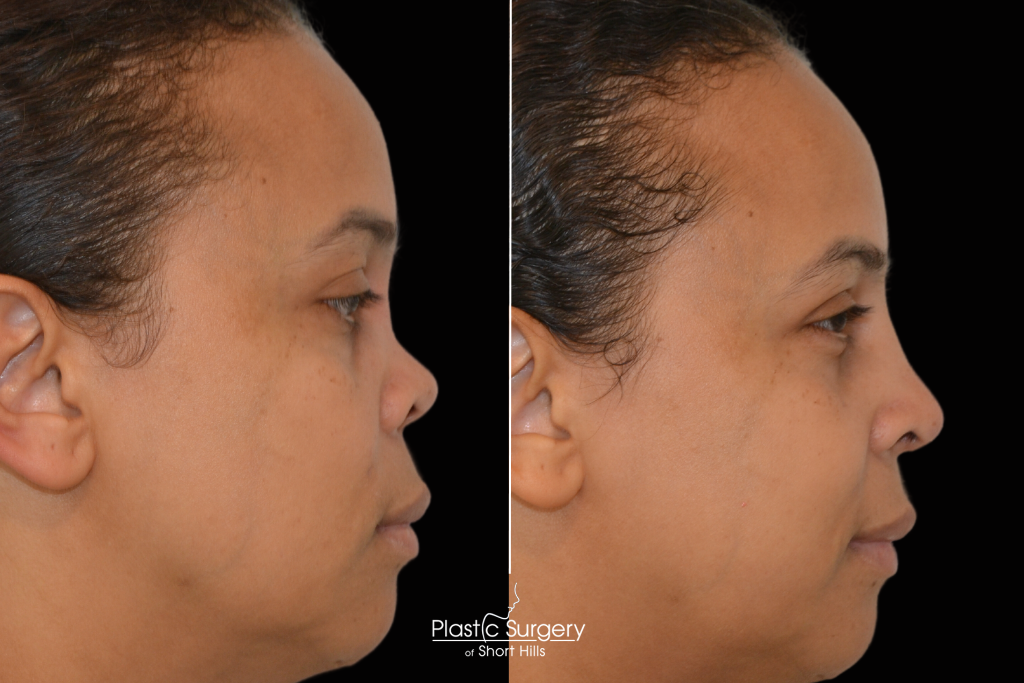 Revision Rhinoplasty Short Hills NJ