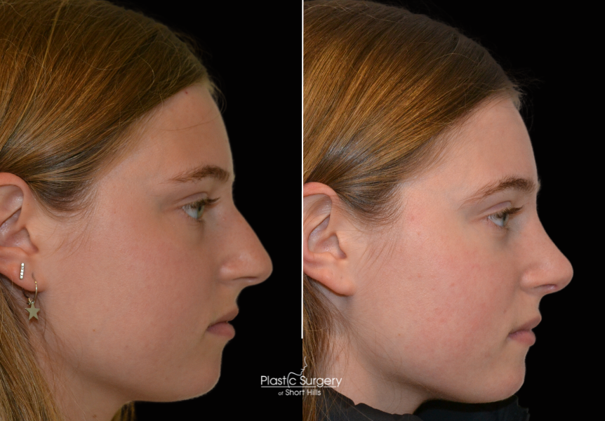 Teenage Rhinoplasty Short Hills NJ