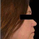 Liposuction-Face Before & After Patient #17790