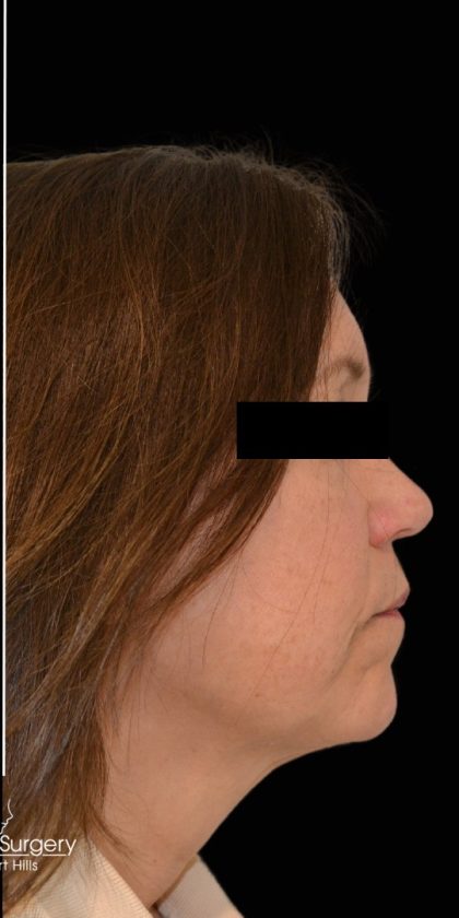 Liposuction-Face Before & After Patient #17790