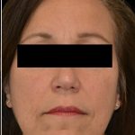 Liposuction-Face Before & After Patient #17790