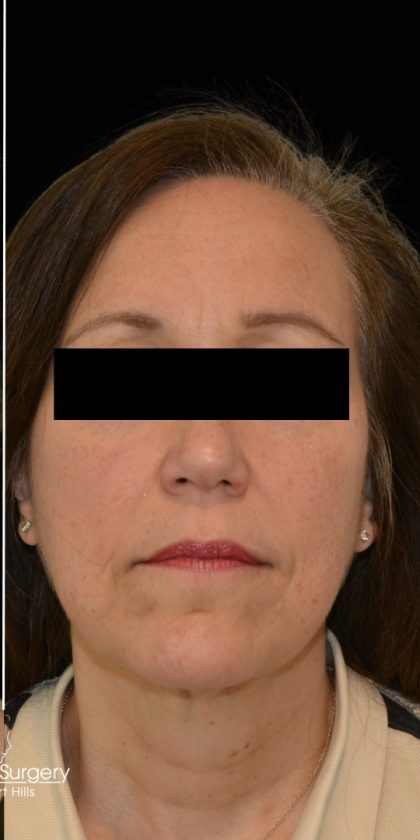 Liposuction-Face Before & After Patient #17790