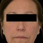 Liposuction-Face Before & After Patient #17790