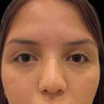 Liquid Rhinoplasty(Non-Surgical) Before & After Patient #17872