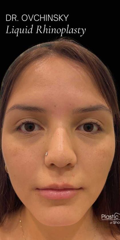 Liquid Rhinoplasty(Non-Surgical) Before & After Patient #17872