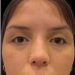 Liquid Rhinoplasty(Non-Surgical) Before & After Patient #17872