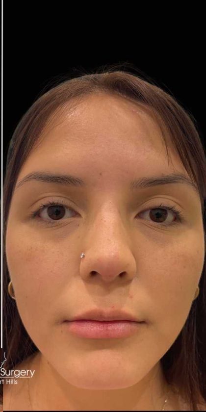 Liquid Rhinoplasty(Non-Surgical) Before & After Patient #17872