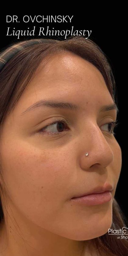 Liquid Rhinoplasty(Non-Surgical) Before & After Patient #17872