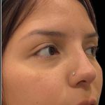 Liquid Rhinoplasty(Non-Surgical) Before & After Patient #17872