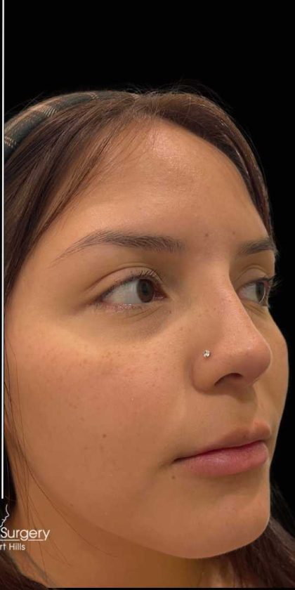 Liquid Rhinoplasty(Non-Surgical) Before & After Patient #17872