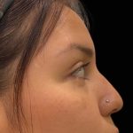 Liquid Rhinoplasty(Non-Surgical) Before & After Patient #17872