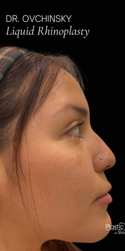 Liquid Rhinoplasty(Non-Surgical) Before & After Patient #17872