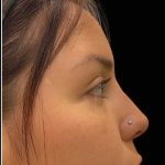 Liquid Rhinoplasty(Non-Surgical) Before & After Patient #17872