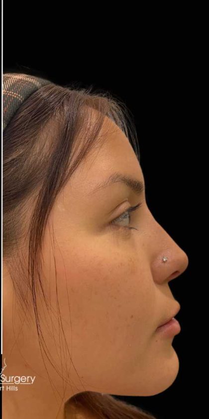 Liquid Rhinoplasty(Non-Surgical) Before & After Patient #17872