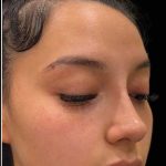 Liquid Rhinoplasty(Non-Surgical) Before & After Patient #17873