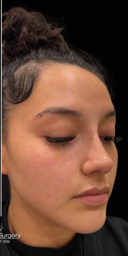 Liquid Rhinoplasty(Non-Surgical) Before & After Patient #17873