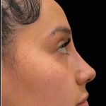 Liquid Rhinoplasty(Non-Surgical) Before & After Patient #17873