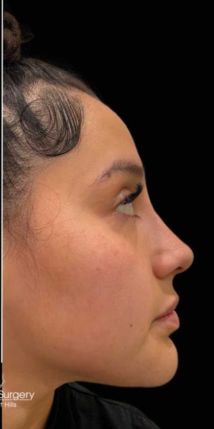 Liquid Rhinoplasty(Non-Surgical) Before & After Patient #17873