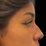 Liquid Rhinoplasty(Non-Surgical) Before & After Patient #17875