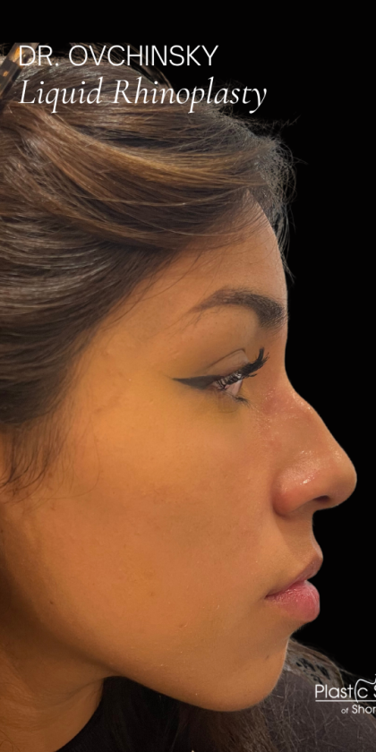 Liquid Rhinoplasty(Non-Surgical) Before & After Patient #17875