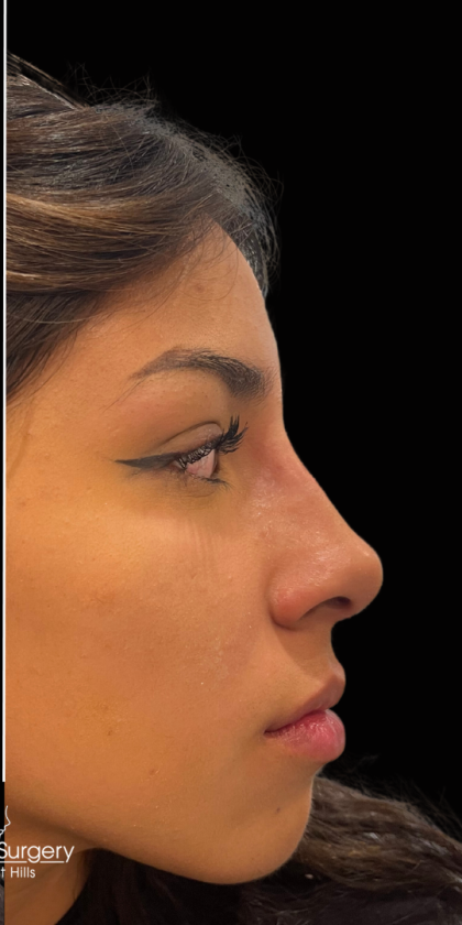 Liquid Rhinoplasty(Non-Surgical) Before & After Patient #17875