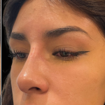 Liquid Rhinoplasty(Non-Surgical) Before & After Patient #17875
