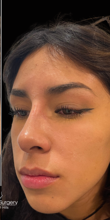 Liquid Rhinoplasty(Non-Surgical) Before & After Patient #17875