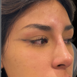 Liquid Rhinoplasty(Non-Surgical) Before & After Patient #17875