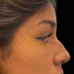 Liquid Rhinoplasty(Non-Surgical) Before & After Patient #17888
