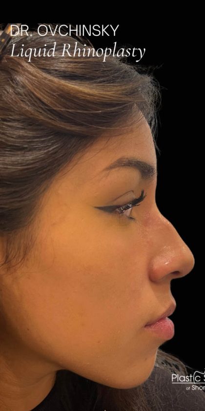 Liquid Rhinoplasty(Non-Surgical) Before & After Patient #17888