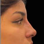 Liquid Rhinoplasty(Non-Surgical) Before & After Patient #17888