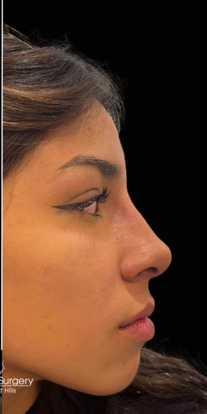 Liquid Rhinoplasty(Non-Surgical) Before & After Patient #17888