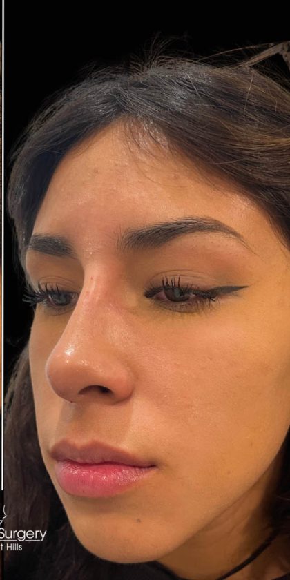 Liquid Rhinoplasty(Non-Surgical) Before & After Patient #17888