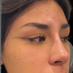Liquid Rhinoplasty(Non-Surgical) Before & After Patient #17888