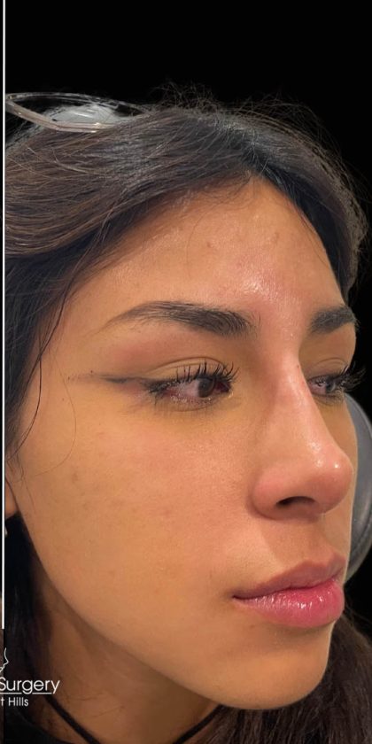 Liquid Rhinoplasty(Non-Surgical) Before & After Patient #17888