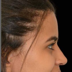 Rhinoplasty Before & After Patient #17874