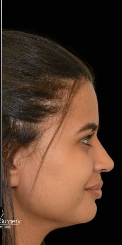 Rhinoplasty Before & After Patient #17874
