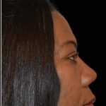 Rhinoplasty Before & After Patient #17941