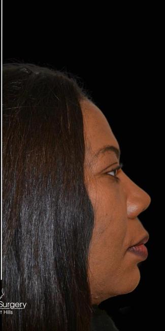 Rhinoplasty Before & After Patient #17941