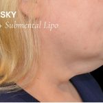 Liposuction-Face Before & After Patient #17985