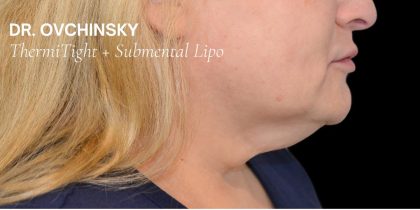 Liposuction-Face Before & After Patient #17985