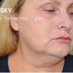 Liposuction-Face Before & After Patient #17985