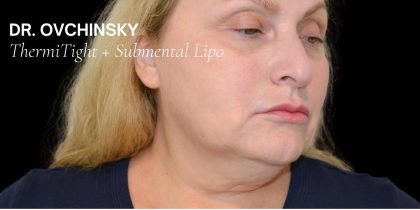 Liposuction-Face Before & After Patient #17985