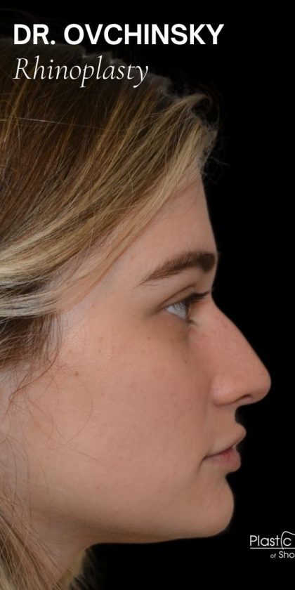 Rhinoplasty Before & After Patient #17987