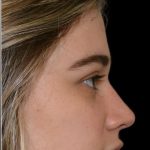 Rhinoplasty Before & After Patient #17987