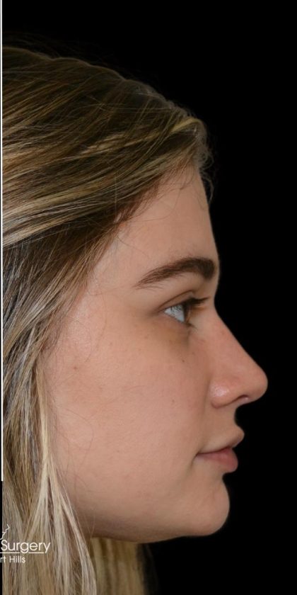 Rhinoplasty Before & After Patient #17987