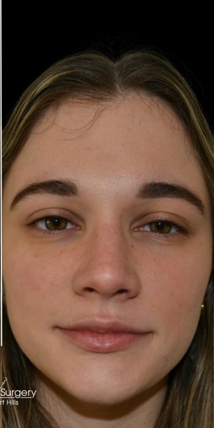 Rhinoplasty Before & After Patient #17987
