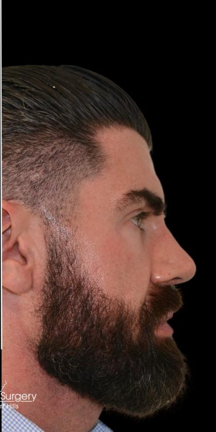Rhinoplasty Before & After Patient #17986